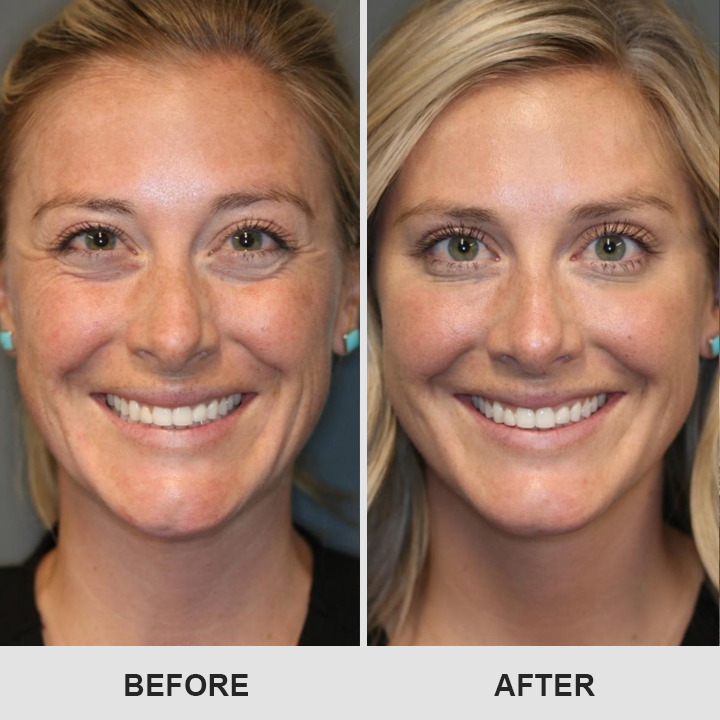 Retinol Eye Stick✅ for Reduces Fine Lines，Puffiness and Dark Circles🌟