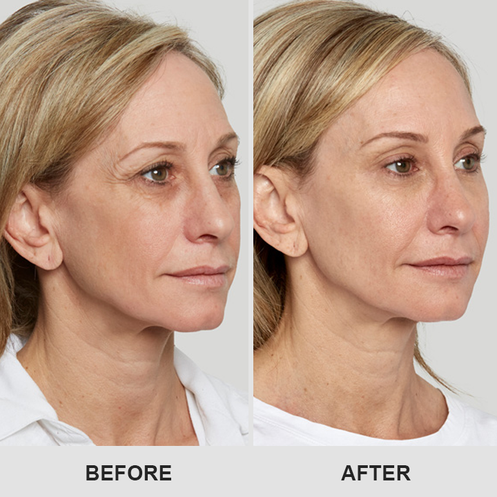 Retinol Eye Stick✅ for Reduces Fine Lines，Puffiness and Dark Circles🌟